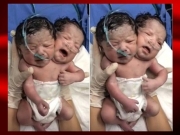 Bebê com duas cabeças nasce no México; veja o vídeo